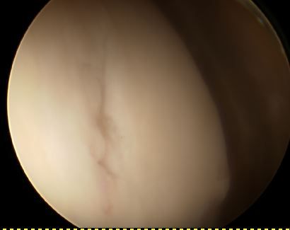 Retropatellar Knorpelschaden.JPG